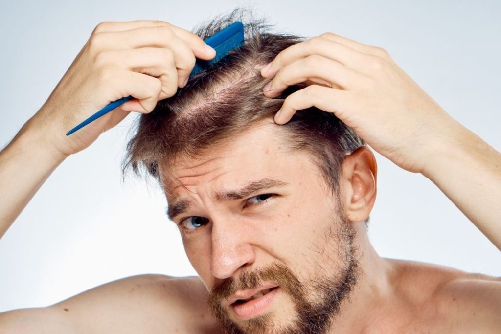 Hair Loss in Men