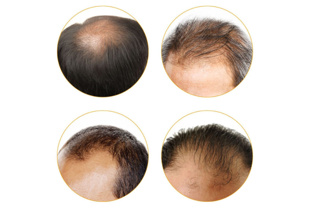 Common Types Of Hair Loss