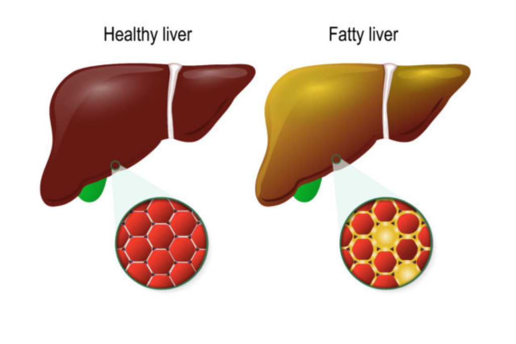 Healthy-liver-and-Fatty-Liver1