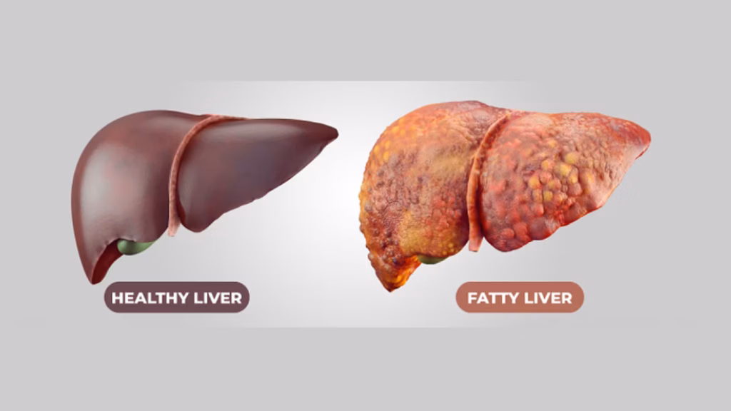 Homeopathic Medicine for Fatty Liver.
