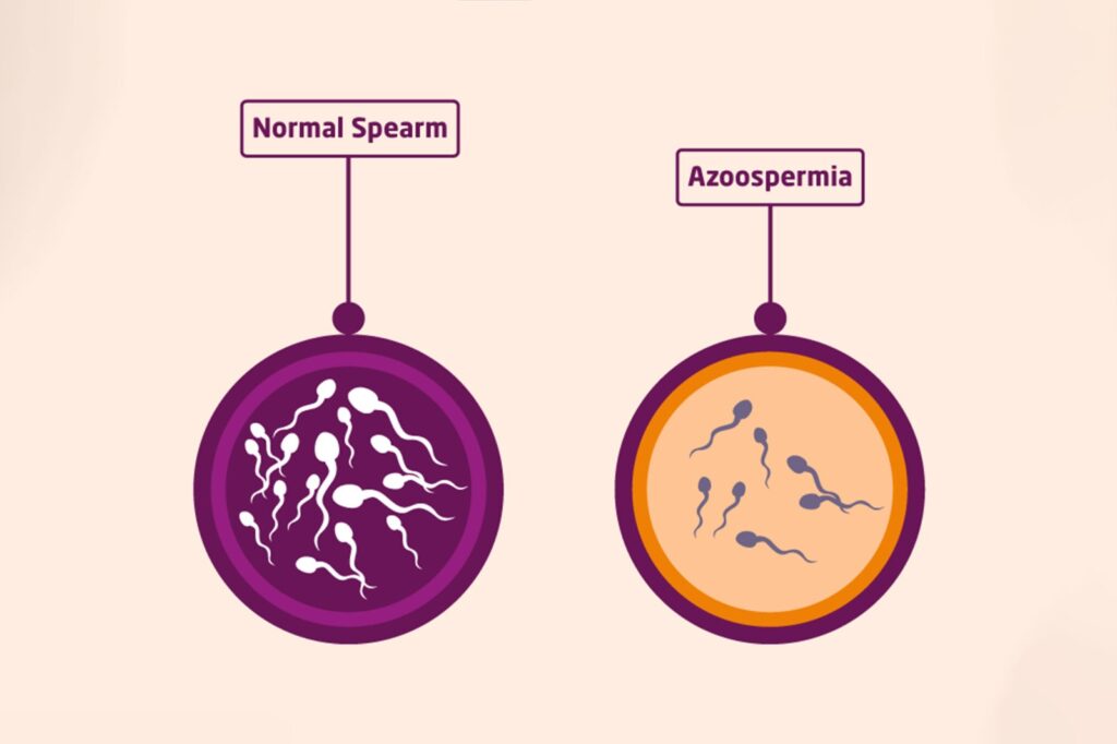 Homeopathic treatment for azoospermia, Best homeo hospital in Kerala - india