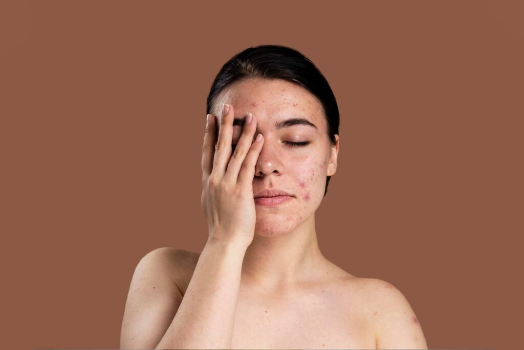 Pimple treatment in Homeopathy at dr Basils Homeo Hospital, Best Hospital In Kerala - india