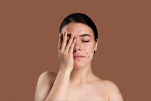 Pimple treatment in Homeopathy at dr Basils Homeo Hospital, Best Hospital In Kerala - india